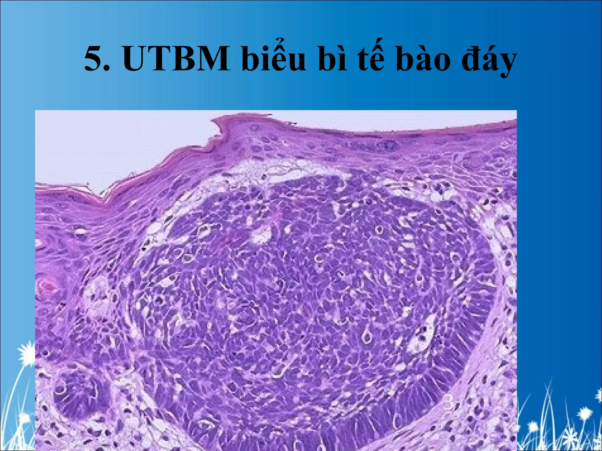 5. UTBM biểu bì tế bào đáy
 