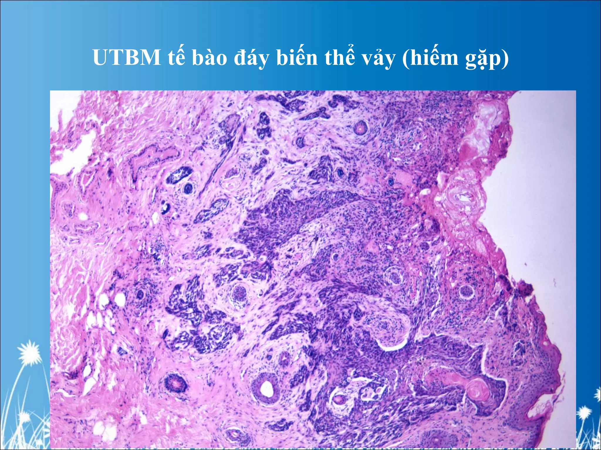 UTBM tế bào đáy biến thể vảy (hiếm gặp)
 