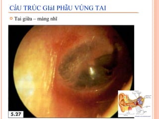 CấU TRÚC GIảI PHẫU VÙNG TAI
   Tai giữa – màng nhĩ
 