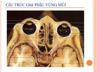 CấU TRÚC GIảI PHẫU VÙNG MŨI
 