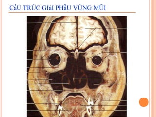 CấU TRÚC GIảI PHẫU VÙNG MŨI
 