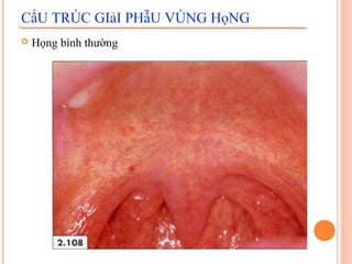 CấU TRÚC GIảI PHẫU VÙNG HọNG
   Họng bình thường
 