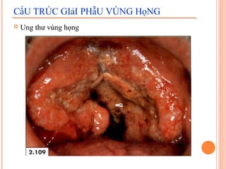CấU TRÚC GIảI PHẫU VÙNG HọNG
   Ung thư vùng họng
 