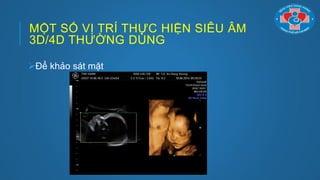 MỘT SỐ VỊ TRÍ THỰC HIỆN SIÊU ÂM
3D/4D THƢỜNG DÙNG
Để khảo sát mặt
 