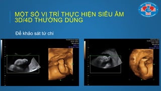 MỘT SỐ VỊ TRÍ THỰC HIỆN SIÊU ÂM
3D/4D THƢỜNG DÙNG
Để khảo sát tứ chi
 