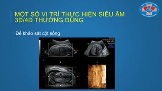 MỘT SỐ VỊ TRÍ THỰC HIỆN SIÊU ÂM
3D/4D THƢỜNG DÙNG
Để khảo sát cột sống
 
