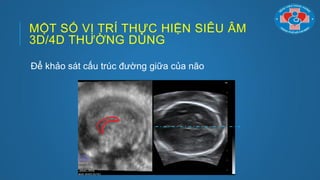 MỘT SỐ VỊ TRÍ THỰC HIỆN SIÊU ÂM
3D/4D THƢỜNG DÙNG
Để khảo sát cấu trúc đƣờng giữa của não
 