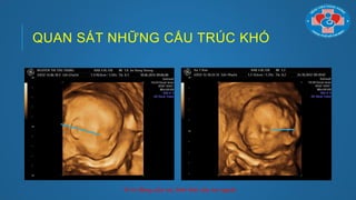 QUAN SÁT NHỮNG CẤU TRÚC KHÓ
Vị trí đóng của tai, hình thái của tai ngoài
 