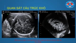 QUAN SÁT CẤU TRÚC KHÓ
Chẩn đoán các bệnh lý cần mặt cắt dọc giữa (thiểu sản/bất sản thể chai, thiểu sản
thùy nhộng)
 