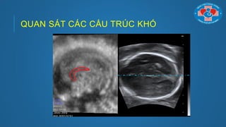 QUAN SÁT CÁC CẤU TRÚC KHÓ
 