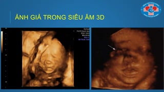 ẢNH GIẢ TRONG SIÊU ÂM 3D
 