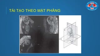 TÁI TẠO THEO MẶT PHẲNG
 