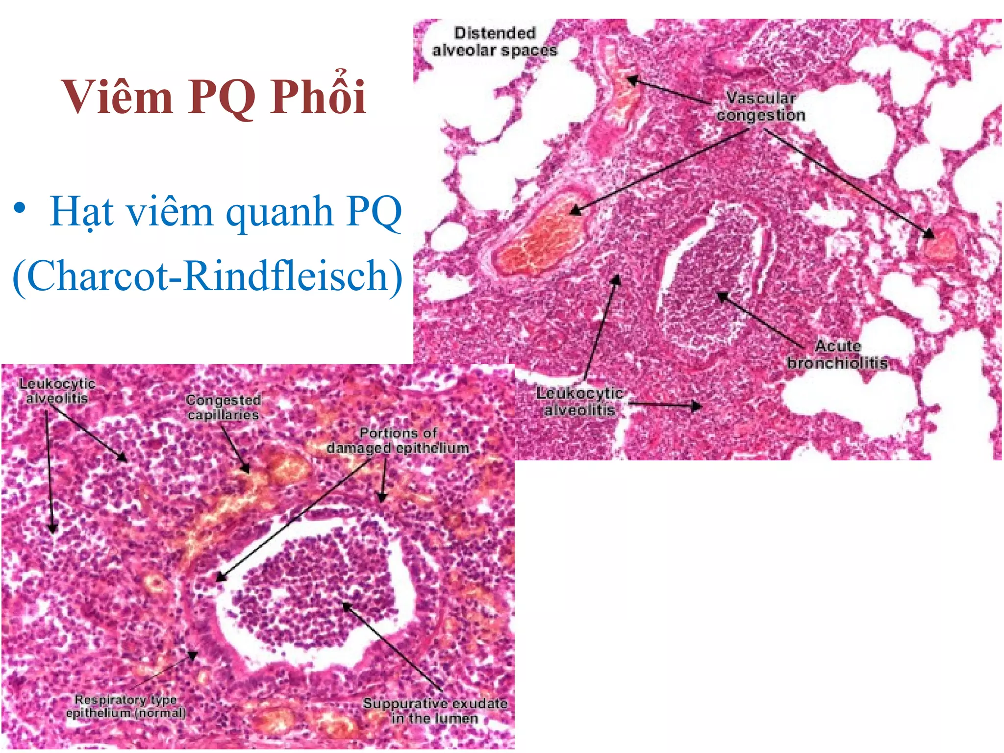 Viêm PQ Phổi
• Hạt viêm quanh PQ
(Charcot-Rindfleisch)
 