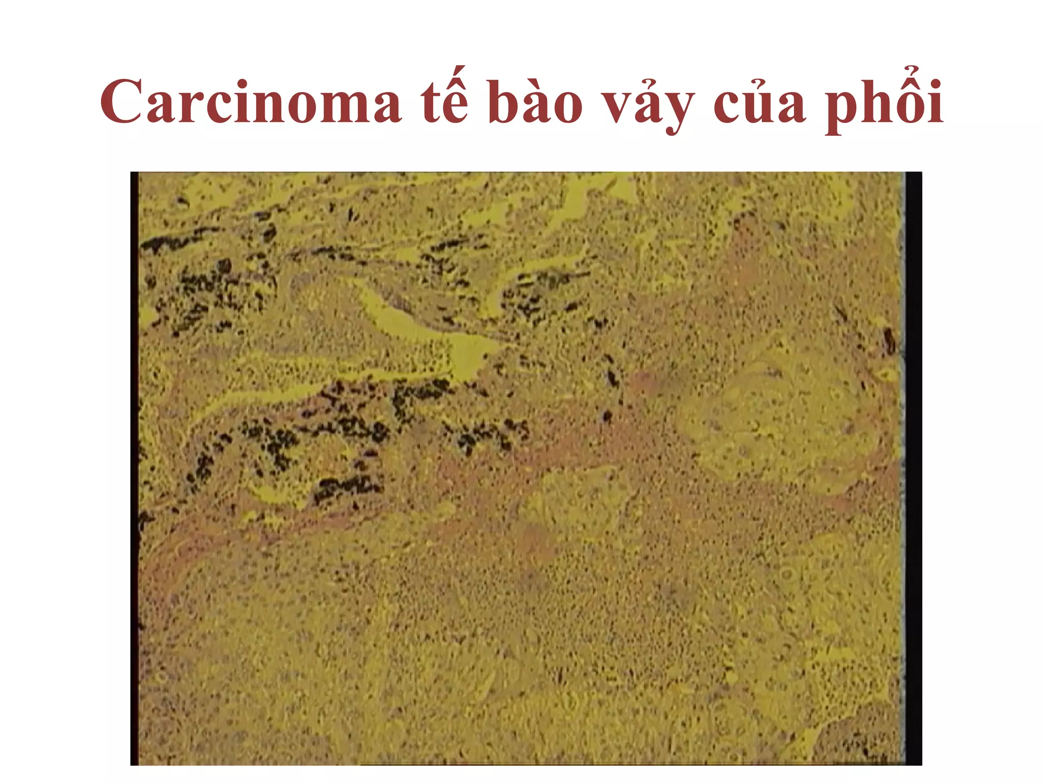 Carcinoma tế bào vảy của phổi
 
