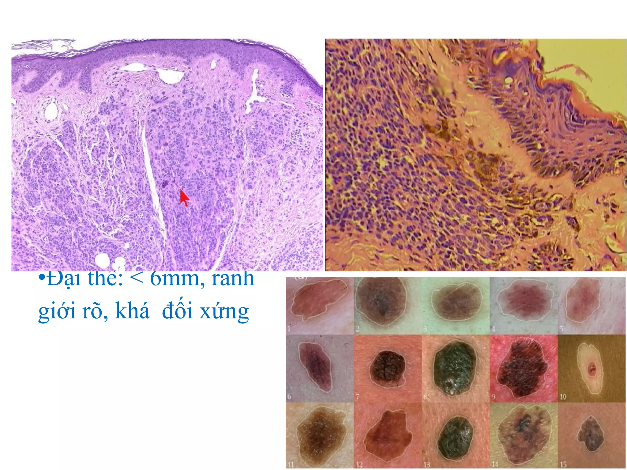 •Đại thể: < 6mm, ranh
giới rõ, khá đối xứng
 