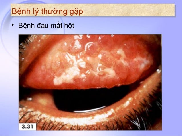 Bai 32 Benh Ve Mat