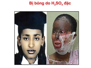 Bị bỏng do H2SO4 đặc
 