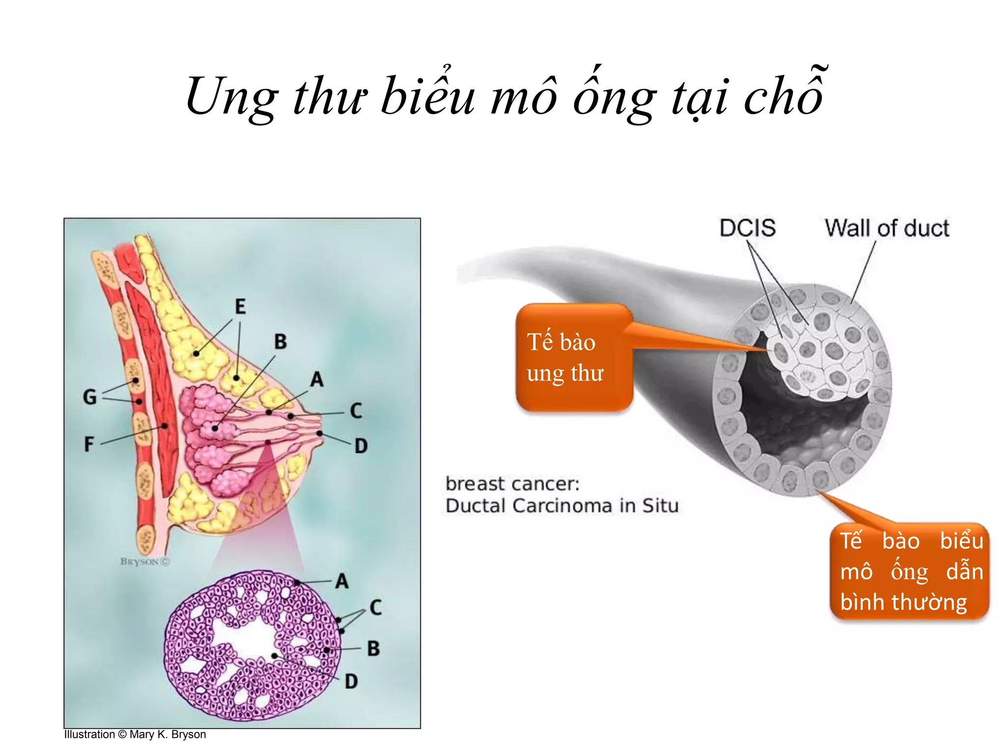Ung thư biểu mô ống tại chỗ
19
Illustration © Mary K. Bryson
Tế bào
ung thư
Tế bào biểu
mô ống dẫn
bình thường
 