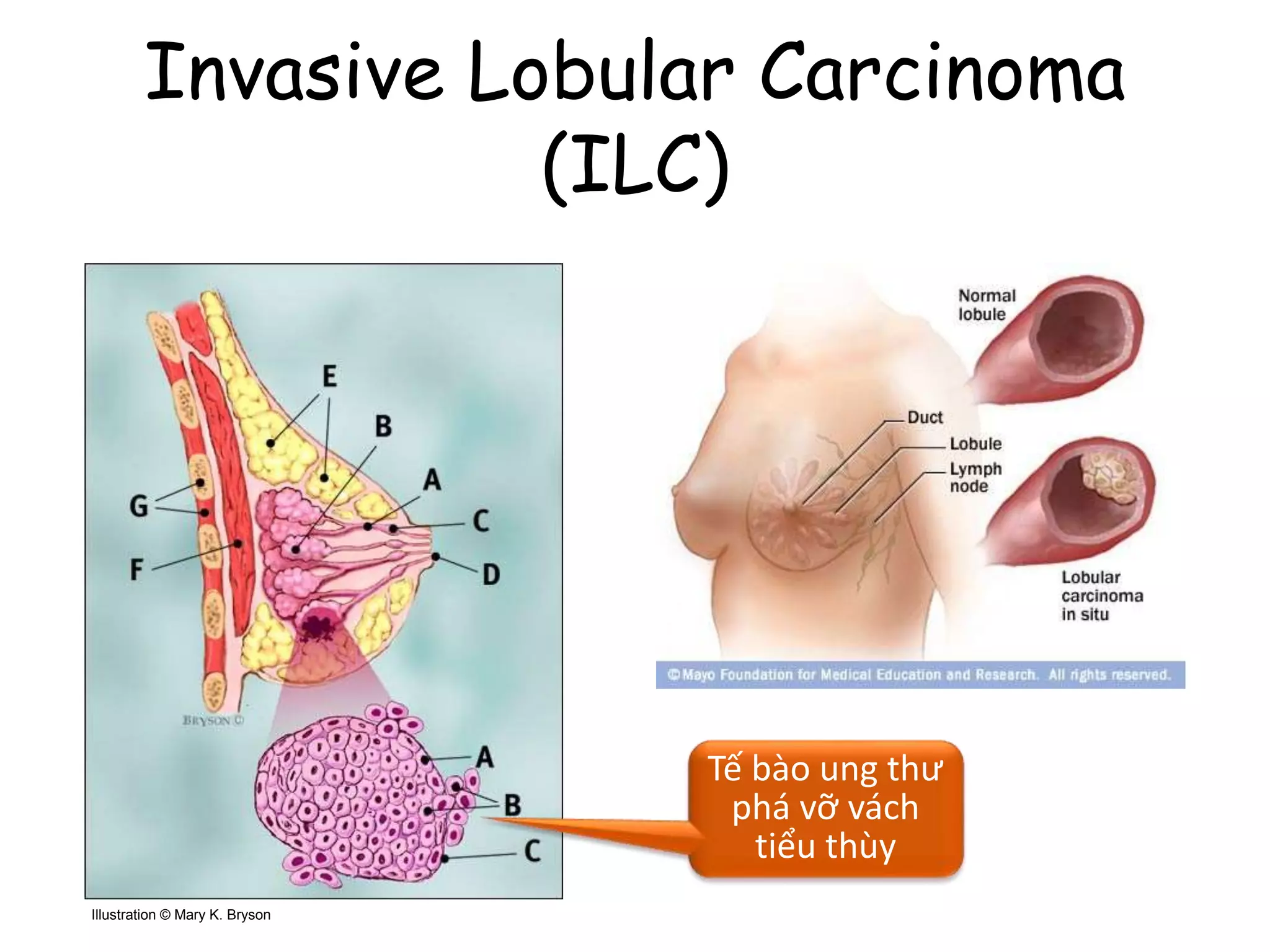 Invasive Lobular Carcinoma
(ILC)
26Illustration © Mary K. Bryson
Tế bào ung thư
phá vỡ vách
tiểu thùy
 