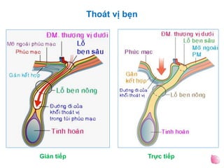 Thoát vị bẹn
Gián tiếp Trực tiếp
 