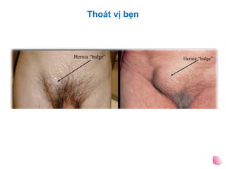 Thoát vị bẹn
 