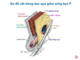 Sơ đồ cắt dứng dọc qua giữa vùng bẹn P
 