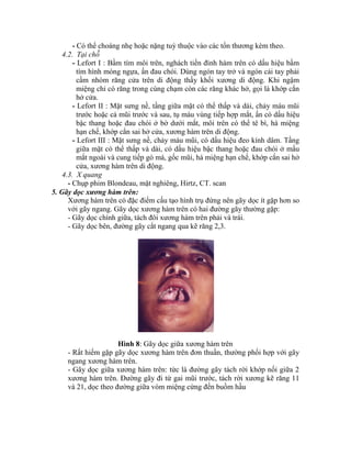- Có thể choáng nhẹ hoặc nặng tuỳ thuộc vào các tổn thương kèm theo.
4.2. Tại chỗ
- Lefort I : Bầm tìm môi trên, nghách tiền đính hàm trên có dấu hiệu bầm
tìm hính móng ngựa, ấn đau chói. Dùng ngón tay trở và ngón cái tay phải
cầm nhóm răng cửa trên di động thấy khối xương di động. Khi ngậm
miệng chỉ có răng trong cùng chạm còn các răng khác hở, gọi là khớp cắn
hở cửa.
- Lefort II : Mặt sưng nề, tầng giữa mặt có thể thấp và dài, chảy máu mũi
trước hoặc cả mũi trước và sau, tụ máu vùng tiếp hợp mắt, ấn có dấu hiệu
bậc thang hoặc đau chói ở bờ dưới mắt, môi trên có thể tê bí, há miệng
hạn chế, khớp cắn sai hở cửa, xương hàm trên di động.
- Lefort III : Mặt sưng nề, chảy máu mũi, có dấu hiệu đeo kình dâm. Tầng
giữa mặt có thể thấp và dài, có dấu hiệu bậc thang hoặc đau chói ở mấu
mắt ngoài và cung tiếp gò má, gốc mũi, há miệng hạn chế, khớp cắn sai hở
cửa, xương hàm trên di động.
4.3. X quang
- Chụp phim Blondeau, mặt nghiêng, Hirtz, CT. scan
5. Gãy dọc xương hàm trên:
Xương hàm trên có đặc điểm cấu tạo hính trụ đứng nên gãy dọc ìt gặp hơn so
với gãy ngang. Gãy dọc xương hàm trên có hai đường gãy thường gặp:
- Gãy dọc chình giữa, tách đôi xương hàm trên phải và trái.
- Gãy dọc bên, đường gãy cắt ngang qua kẽ răng 2,3.
Hình 8: Gãy dọc giữa xương hàm trên
- Rất hiếm gặp gãy dọc xương hàm trên đơn thuần, thường phối hợp với gãy
ngang xương hàm trên.
- Gãy dọc giữa xương hàm trên: tức là đường gãy tách rời khớp nối giữa 2
xương hàm trên. Đường gãy đi từ gai mũi trước, tách rời xương kẽ răng 11
và 21, dọc theo đường giữa vòm miệng cứng đến buồm hầu
 