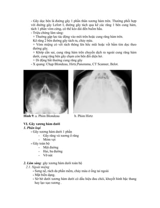 - Gãy dọc bên là đường gãy 1 phần thân xương hàm trên. Thường phối hợp
với đường gãy Lefort I, đường gãy tách qua kẽ các răng 1 bên cung hàm,
tách 1 phần vòm cứng, có thể kéo dài đến buồm hầu.
- Triệu chứng lâm sàng:
+ Thường gặp lực tác động vào môi trên hoặc cung răng hàm trên.
Kẽ răng 2 bên đường gãy tách ra, chảy máu.
+ Vòm miệng có vết rách thông lên hốc mũi hoặc vết bầm tìm dọc theo
đường gãy.
+ Khớp cắn sai, cung răng hàm trên chuyển dịch ra ngoài cung răng hàm
dưới, cung răng bên gãy chạm còn bên đối diện hở.
+ Di động bất thường cung răng gãy
- X quang: Chụp Blondeau, Hirtz,Panorama, CT Scanner, Belot.
Hình 9: a. Phim Blondeau b. Phim Hirtz
VI. Gãy xƣơng hàm dƣới
1. Phân loại
- Gãy xương hàm dưới 1 phần
- Gãy răng và xương ổ răng
- Mỏm vẹt
- Gãy toàn bộ
- Một đường
- Hai, ba đường
- Vỡ nát
2. Lâm sàng: gãy xương hàm dưới toàn bộ
2.1. Ngoài miệng
- Sưng nề, rách da phần mềm, chảy máu ở ống tai ngoài
- Mặt biến dạng.
- Sờ bờ dưới xương hàm dưới có dấu hiệu đau chói, khuyết hính bậc thang
hay lạo xạo xương .
 