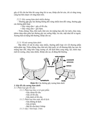 gãy cổ lồi cầu hai bên thí cung răng lùi ra sau, khớp cắn hở cửa, chỉ có răng trong
cùng hai bên chạm với răng hàm trên.
2.2.2. Gãy xương hàm dưới nhiều đường
- Thường gặp gãy hai đường không đối xứng nhiều hơn đối xứng, thường gặp
các đường phối hợp:
+ Gãy vùng cằm + gãy cổ lồi cầu.
+ Gãy vùng cằm + góc hàm.
- Triệu chứng: Đau, khó nuốt, khó nói, há miệng hạn chế, lợi rách, chảy máu,
nhóm răng nằm giữa hai đường gãy tụt xuống thấp, ría cắn, mặt nhai đổ ra ngoài.
Xương hàm di động bất thường, khớp cắn sai.
2.2.3. Vỡ nát xương hàm dưới:
Đặc điểm vỡ nát là chảy máu nhiều, thường phối hợp với vết thương phần
mềm phức tạp. Triệu chứng: đau, khó nói, khó nuốt, sờ vết thương thấy lạo xạo, há
miệng hạn chế, răng trên vùng xương vỡ, đổ lệch khỏi cung răng, lợi, niêm mạc
rách lộ xương, chảy máu nhiều. Khớp cắn sai, di động bất thường.
Hình 10: Các đường gãy xương hàm dưới
3. Gãy lồi cầu xương hàm dưới:
3.1. Phân loại gãy lồi cầu:
3.1.1. Phân loại theo vị trí giải phẫu:
- Gãy chỏm lồi cầu.
- Gãy cổ lồi cầu.
- Gãy dưới cổ lồi cầu.
3.1.2. Phân loại theo mức độ di lệch:
- Gãy không di lệch.
- Gãy di lệch.
- Bật lồi cầu khỏi ổ khớp
3.1.3. Gãy 1 bên hoặc 2 bên:
 