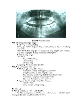 Hình 11: Phim Panorama
VII. Gãy răng và xƣơng ổ răng:
1. Gãy răng và xương ổ răng
Thường gặp ở nhóm răng cửa. Răng và xương ổ răng bị đẩy vào phìa trong
và chồi lên.
Khám thấy 1 nhóm răng lệch vào trong so với cung răng lợi rách, bầm tìm,
chảy máu, di động bất thường, cắn răng hàm không khìt
2. Chấn thương răng:
Gồm 2 loại:
- Răng bật khỏi ổ răng.
- Gãy thân răng.
- Gãy chân răng.
3. X-quang: Panorama, phim cận chóp.
VIII. Gãy xƣơng hàm ở trẻ em:
1. Đặc điểm gãy xương hàm ở trẻ em:
- Xương hàm ở trẻ em thường gãy kiểu cành tươi.
- Trong lòng xương có mầm răng vĩnh viễn.
- Răng trên cung hàm là răng sữa hoặc hàm răng hỗn hợp.
- Xương hàm dưới có các trung tâm phát triển.
- Bệnh nhân thường không hợp tác điều trị
2. Nguyên tắc điều trị gãy xương hàm ở trẻ em:
- Cố định 1 hàm
- Chống chỉ định kết hợp xương.
IX. Điều trị:
1. Thái độ xử trí trước 1 bệnh nhân CTHM:
1.1. Khai thác bệnh sử và diễn biến của bệnh nhân qua : bệnh nhân, người
nhà, người đưa bệnh nhâ, hồ sơ của tuyến trước.
 