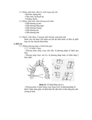 1.2. Khám, phát hiện, điều trị, tình trạng cấp cứu:
- Khó thở, ngừng thở.
- Chảy máu, tụt huyết áp
- Choáng, shock.
1.3. Khám, phát hiện chấn thương toàn thân:
- Chấn thương sọ não
- Chấn thương lồng ngực
- Chấn thương ổ bụng
- Chấn thương chi
- Chấn thương mắt
....
1.4. Khám, chẩn đoán, X-quang chấn thương vùng hàm mặt.
Bước này chỉ được tiến hành sau khi đã chẩn đoán và điều trị phối
hợp với các chuyên khoa khác
2. Điều trị:
2.1. Những phương pháp cố định hàm gãy:
2.1.1. Cố định 2 hàm:
- Phương pháp băng vòng cằm đầu: là phương pháp cố định tạm
thời.
- Phương pháp buộc nút Ivy: là phương pháp buộc cố định răng 2
hàm chặt.
Hình 12: Cố định bằng nút Ivy
- Phương pháp cố định bằng cung Tiguersted: là phương pháp cố
định 2 hàm chun giãn, cố định hàm tốt, đặc biệt có khả năng kéo nắn
xương di lệch.
 