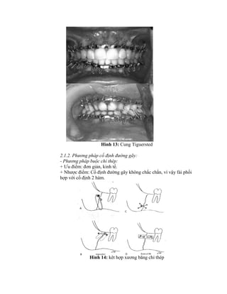 Hình 13: Cung Tiguersted
2.1.2. Phương pháp cố định đường gãy:
- Phương pháp buộc chỉ thép:
+ Ưu điểm: đơn giản, kinh tế.
+ Nhược điểm: Cố định đường gãy không chắc chắn, ví vậy fải phối
hợp với cố định 2 hàm.
Hình 14: kết hợp xương bằng chỉ thép
 