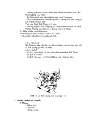 - Phương pháp treo Adams: do Milton Adams đưa ra vào năm 1942.
Phương pháp có 2 bước:
+ Cố định răng 2 hàm bằng nút Ivy hoặc cung Tiguersted.
+ Treo xương hàm trên vào mấu ngoài của xương trán, hoặc cung gò
má, hoặc bờ dưới ổ mắt.
Thời gian đó cố định 2 hàm 4 - 5 tuần.
- Phương pháp cố định bằng nẹp vít: Dùng miniplate đặt ở các vị trì
trụ lực. Phương pháp này chỉ cố định 2 hàm từ 1-2 tuần.
2.3. Điều trị gãy xương hàm dưới:
+ Gãy không di lệch: cố định 2 hàm từ 6 - 8 tuần.
+ Gãy di lệch: nắn chỉnh xương gãy, cố định.
2.3.1. Nắn chỉnh:
Bộc lộ đường gãy, nắn cho răng hàm dưới cắn khìt với răng hàm trên
và diện xương gãy khìt với nhau.
2.3.2. Cố định:
- Kết hợp xương bằng chỉ thép: phải phối hợp với cố định 2 hàm.
Thời gian 4 - 6 tuần.
- Cố định bằng nẹp – vít: Có thể không phải cố định 2 hàm.
Hình 16: Cố định xương hàm bằng nẹp – vít
X. Điều trị và theo dõi sau mổ:
1. Thuốc:
- Kháng sinh.
- Giảm đau
- Chống phù nề
 