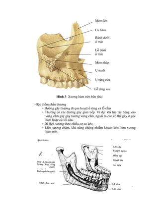 Hình 3: Xương hàm trên bên phải
-Đặc điểm chấn thương
+ Đường gãy thường đi qua huyệt ổ răng và lỗ cằm
+ Thường có các đường gãy gián tiếp. Vì dụ: khi lực tác động vào
vùng cằm gây gãy xương vùng cằm, ngoài ra còn có thể gãy ở góc
hàm hoặc cổ lồi cầu.
+ Di lệch xương theo chiều cơ co kéo
+ Liền xương chậm, khả năng chống nhiễm khuẩn kém hơn xương
hàm trên
Mỏm lên
Củ hàm
Rãnh dưới
ổ mắt
Lỗ dưới
ổ mắt
Mỏm tháp
Ụ nanh
Lỗ răng sau
Ụ răng cửa
 