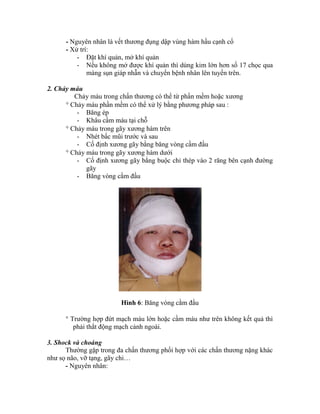 - Nguyên nhân là vết thương đụng dập vùng hàm hầu cạnh cổ
- Xử trì:
- Đặt khì quản, mở khì quản
- Nếu không mở được khì quản thí dùng kim lớn hơn số 17 chọc qua
màng sụn giáp nhẫn và chuyển bệnh nhân lên tuyến trên.
2. Chảy máu
Chảy máu trong chấn thương có thể từ phần mềm hoặc xương
 Chảy máu phần mềm có thể xử lý bằng phương pháp sau :
- Băng ép
- Khâu cầm máu tại chỗ
 Chảy máu trong gãy xương hàm trên
- Nhét bấc mũi trước và sau
- Cố định xương gãy bằng băng vòng cầm đầu
 Chảy máu trong gãy xương hàm dưới
- Cố định xương gãy bằng buộc chỉ thép vào 2 răng bên cạnh đường
gãy
- Băng vòng cằm đầu
Hình 6: Băng vòng cằm đầu
 Trường hợp đứt mạch máu lớn hoặc cầm máu như trên không kết quả thí
phải thắt động mạch cảnh ngoài.
3. Shock và choáng
Thường gặp trong đa chấn thương phối hợp với các chấn thương nặng khác
như sọ não, vỡ tạng, gãy chi…
- Nguyên nhân:
 