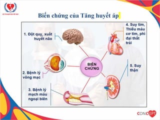 Biến chứng của Tăng huyết áp
 