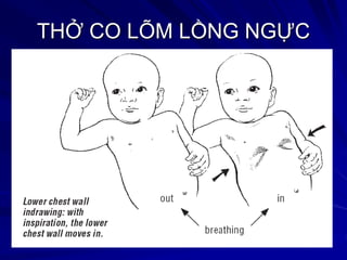 THỞ CO LÕM LỒNG NGỰC
 