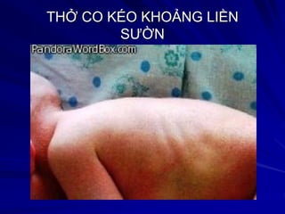 THỞ CO KÉO KHOẢNG LIỀN
SƯỜN
 