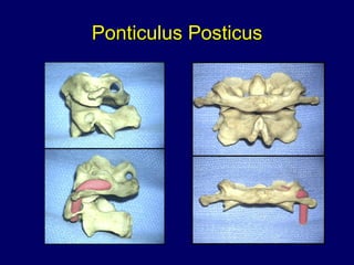 Ponticulus Posticus 