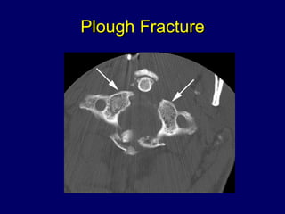 Plough Fracture 