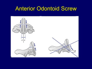 Anterior Odontoid Screw 