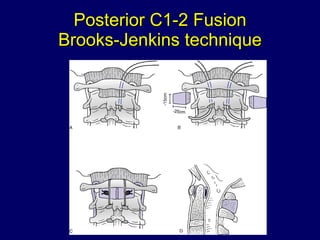 Posterior C1-2 Fusion Brooks-Jenkins technique 