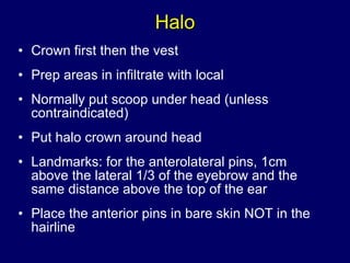 Halo Crown first then the vest Prep areas in infiltrate with local Normally put scoop under head (unless contraindicated) Put halo crown around head Landmarks: for the anterolateral pins, 1cm above the lateral 1/3 of the eyebrow and the same distance above the top of the ear  Place the anterior pins in bare skin NOT in the hairline 