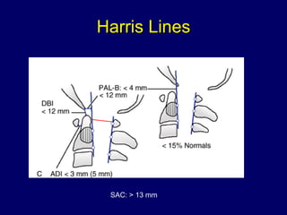 Harris Lines SAC: > 13 mm 