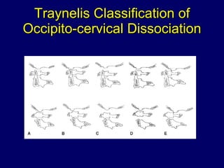 Traynelis Classification of Occipito-cervical Dissociation 
