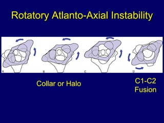 Rotatory Atlanto-Axial Instability Collar or Halo C1-C2 Fusion 
