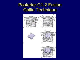 Posterior C1-2 Fusion Gallie Technique 