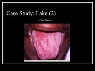 Case Study: Lake (2) Oral Thrush 