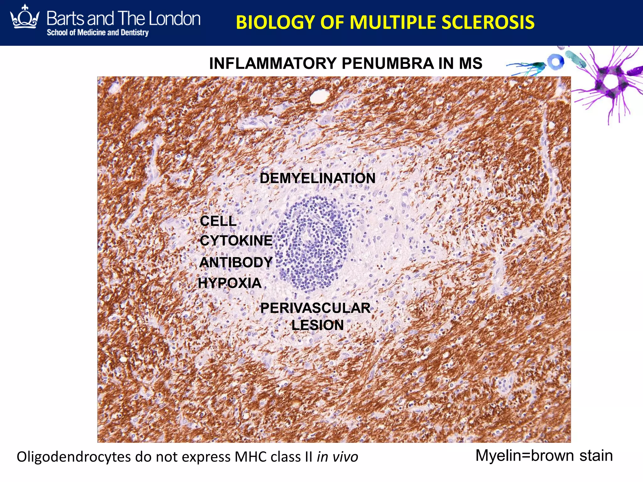 INFLAMMATORY PENUMBRA IN MS
MYELIN = BROWN
DEMYELINATION
PERIVASCULAR
LESION
RELAPSING MS
BIOLOGY OF MULTIPLE SCLEROSIS
Myelin=brown stainOligodendrocytes do not express MHC class II in vivo
ANTIBODY
CYTOKINE
CELL
HYPOXIA
 