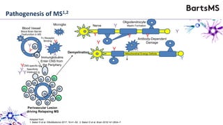 Perivascular Lesion
driving Relapsing MS
Blood Vessel
Blood Brain Barrier
Dysfunction in MS
Immunglobulins
Enter CNS from
the Periphery
Y
Y
YY
Y
Y
Y
Y
Antibody-Dependent
Damage
Y
Microglia
Y
Y
Y
Y
Y
CNS-specific Ig
Specificity
Irrelevant Ig
Mitochondrial Energy DeficitsDemyelination
Nerve
Oligodendrocyte
Myelin Formation
Y
Y
Y
Fc Receptor
Binding
Adapted from:
1. Baker D et al. EBioMedicine 2017; 16:41–50; 2. Baker D et al. Brain 2018;141:2834–7.
Pathogenesis of MS1,2
 